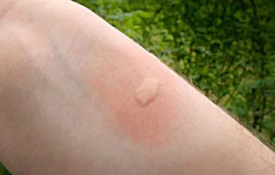 Почему чешется место после укуса комара? - Срочные новости Узбекистана:  Repost.uz