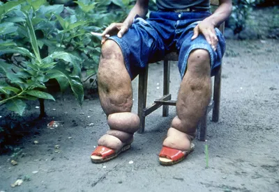 Укус комара превратил пакистанца в инвалида с огромными ногами