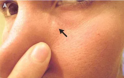 У россиянки после укуса комара под кожей лица поселились черви. Фотофакт |  EX-PRESS.LIVE