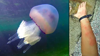 Проверил на себе укус медузы в Атлантическом океане 🐙 Разница между фото 1  час — Александр Кудряшов на TenChat.ru