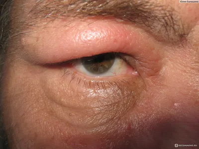Средства для лечения аллергии Novartis Фенистил гель - «Если укусила оса +  Фото До и После» | отзывы