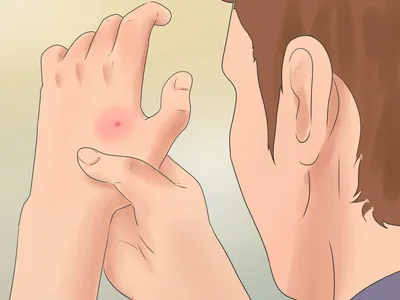 Как вылечить укус паука - wikiHow