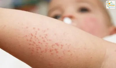 Аллергия на блошиные укусы угрожает развитием инфекции - Все про аллергию