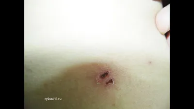 Укусы насекомых фото на коже человека. | Рыбачил.ru