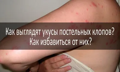 Укусы домашних клопов, как проявляются и лечатся у человека?