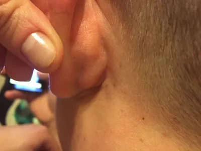 Шишка за ухом – отчего возникает и насколько это серьезно | Новости Туапсе