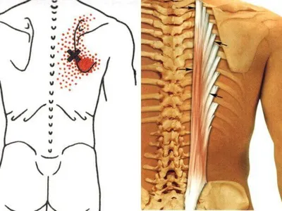 Триггерные точки: узелки в мышцах - как убрать боль? | МЦ AXON.