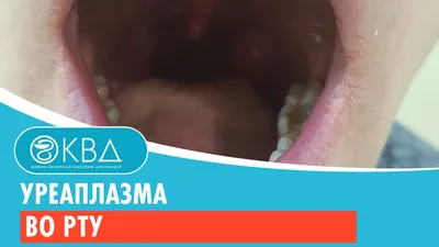 👅 Уреаплазма во рту. Клинический случай №297 - YouTube