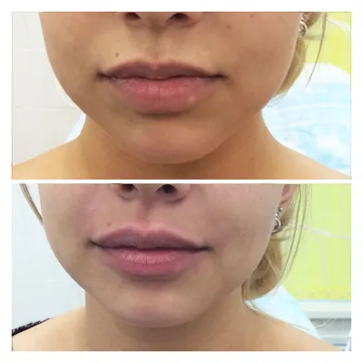 Увеличение губ — Сеть косметологических клиник Эпилайк