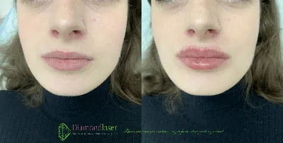 Увеличение губ в Киеве - Diamond Laser