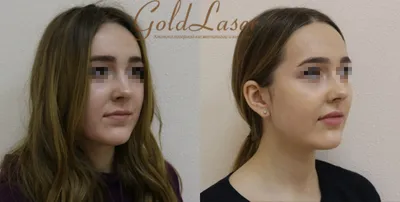 Увеличение губ гиалуроновой кислотой в Киеве: цены, фото до и после, отзывы  о клинике Gold Laser.