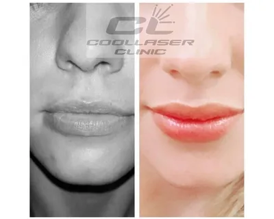 Увеличение губ: гайд 2022-2023 года - Coolaser Clinic