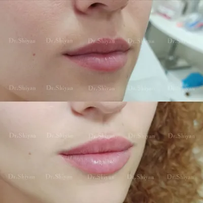 Увеличение губ и бьютификация губ. До и После (Фото)