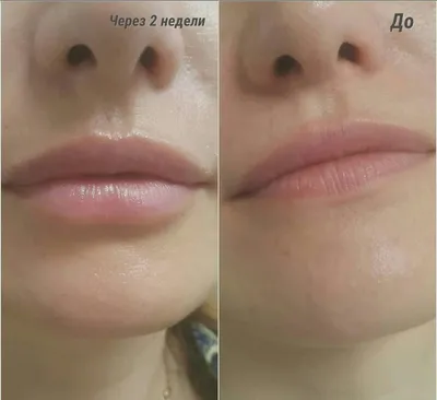 Тонкие губы после гиалуроновой кислоты - 80 фото