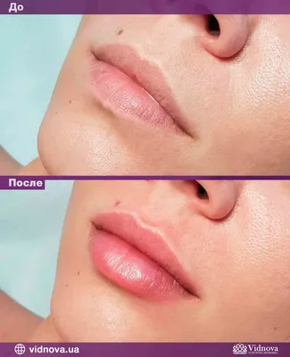 Збільшення губ: Фото До та Після | Vidnova