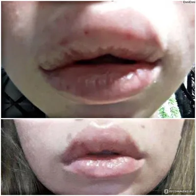 Увеличение / Аугментация губ с помощью препарата гиалуроновой кислоты -  «Ужасная аллергическая реакция на процедуру + фото. Покажу как разнесло мои  губы от 0.5 мл.» | отзывы