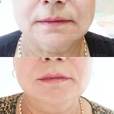 Увеличение губ и бьютификация губ. До и После (Фото)