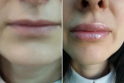 Тонкие губы после гиалуроновой кислоты - 80 фото
