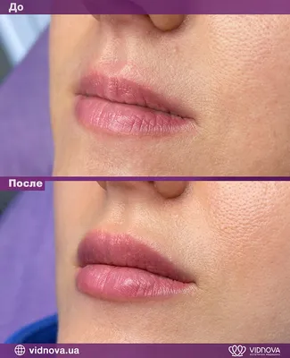 Збільшення губ: Фото До та Після | Vidnova