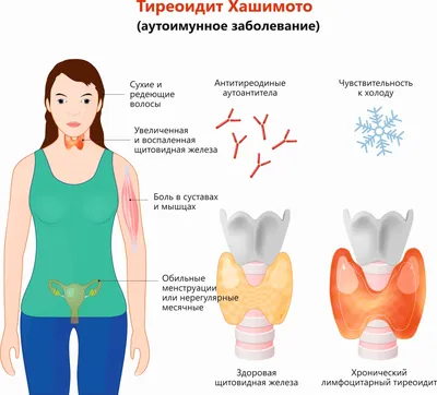 Симптомы и лечение тиреоидита