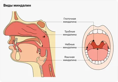 Удаление миндалин: цена, методы, нужен ли наркоз, как проходит,  восстановление, отзыв после операции у взрослых