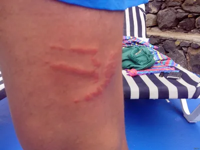 Вот так выглядела моя нога после того как меня ужалила медуза на Мадейре.  На фото с момента контакта с её щупальцами прошла уже неделя. | Пикабу
