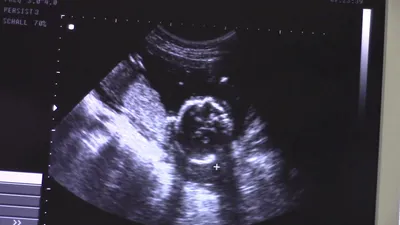 Мальчик или девочка? 3D УЗИ, допплерография. 18 недель беременности -  YouTube