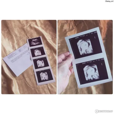 Фото УЗИ при беременности - «Чем платное узи, лучше бесплатного? Почему  обещали мальчика, а родилась девочка? Почему ставили \