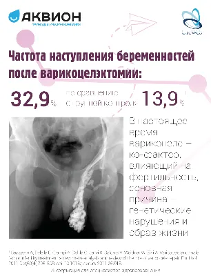 Варикоцеле и мужская фертильность | UroWeb.ru — Урологический  информационный портал!
