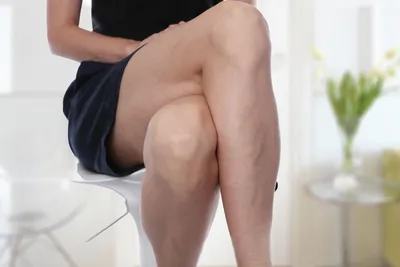 Варикоз на ногах: симптомы у женщин и мужчин, причины расширения вен,  лечение
