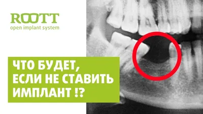 Верхний зубной протез: стоимость и виды протезирования верхней челюсти —  ROOTT