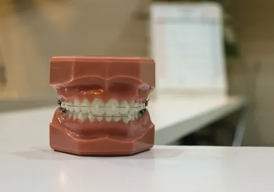 Виды съемных зубных протезов – частичные, полные и на два зуба:  искусственное протезирование челюсти на крючках и ее установка – как  крепится, ставится, делается и что это такое