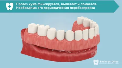 Съемные зубные протезы при полном отсутствии зубов в Москве