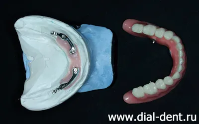 Съемные протезы на имплантах при полном отсутствии зубов