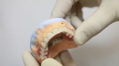 Съемные зубные протезы в Новосибирске, цены на съемное протезирование,  полные или частичные протезы в стоматологии Блеск.