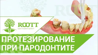 Съемные нейлоновые зубные протезы: цена установки полного и частичного  протеза из нейлона — ROOTT