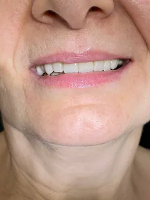 Съемный протез и МК-коронки на 17 и 27 зуб | Примеры работ - фото до и после