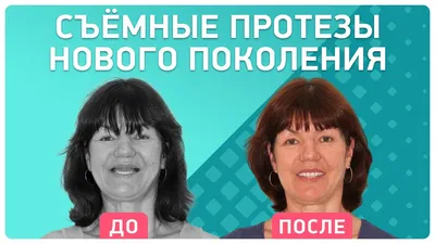 Съемный зубной протез нового поколения 👉 отзыв пациентки о лечении в  клинике Smile-at-Once - YouTube