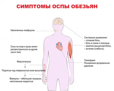 Ветряная оспа Зуд ребенка Кожная сыпь Инфекция, детская, еда, лицо, люди  png | PNGWing