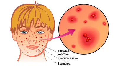 Ветрянка у взрослых