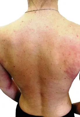 Аллергия на коже: 85 фото как выглядит аллергия и обзор основных ее  проявлений
