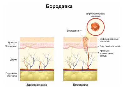 Как удалить бородавку в домашних условиях - лечение бородавок дома