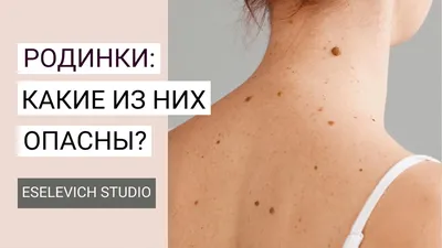 Что делать с родинками, невусами? Услуги удаления родинок