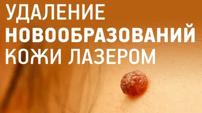 Удаление новообразований лазером в клинике Лазерный Доктор Москва