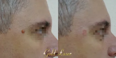 Удаление родинок лазером в Киеве - цена на лазерное удаление невусов в Gold  Laser