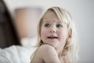Сыпь на ладонях и ступнях у ребёнка: причины, аллергия | WDAY