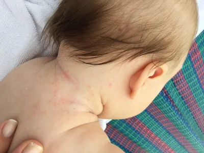 Сыпь на шее у ребенка: аллергия и другие причины, виды высыпаний с фото,  лечение
