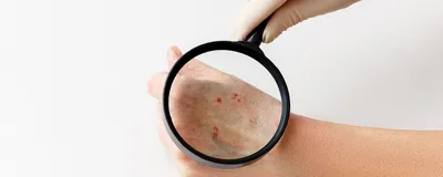 Сыпь на теле - заболевания кожи — Семейная консультация