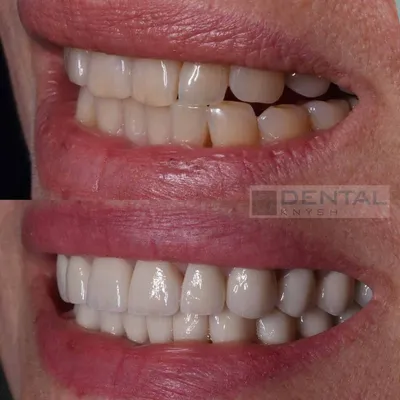 Виниры До После | Стоматология DentalKnysh Львов