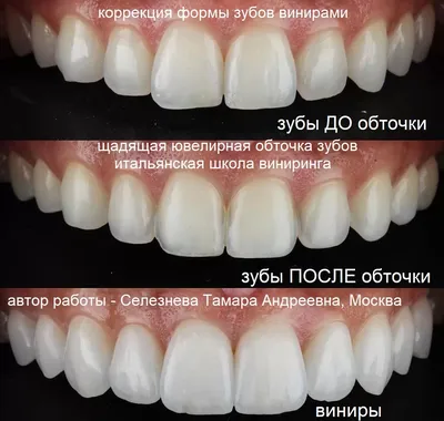 Виниры фотографии